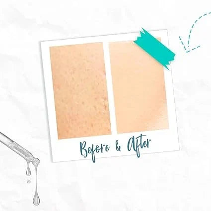 Bye Bye Blemish Skin Rescue Serum — CLIPRONS
